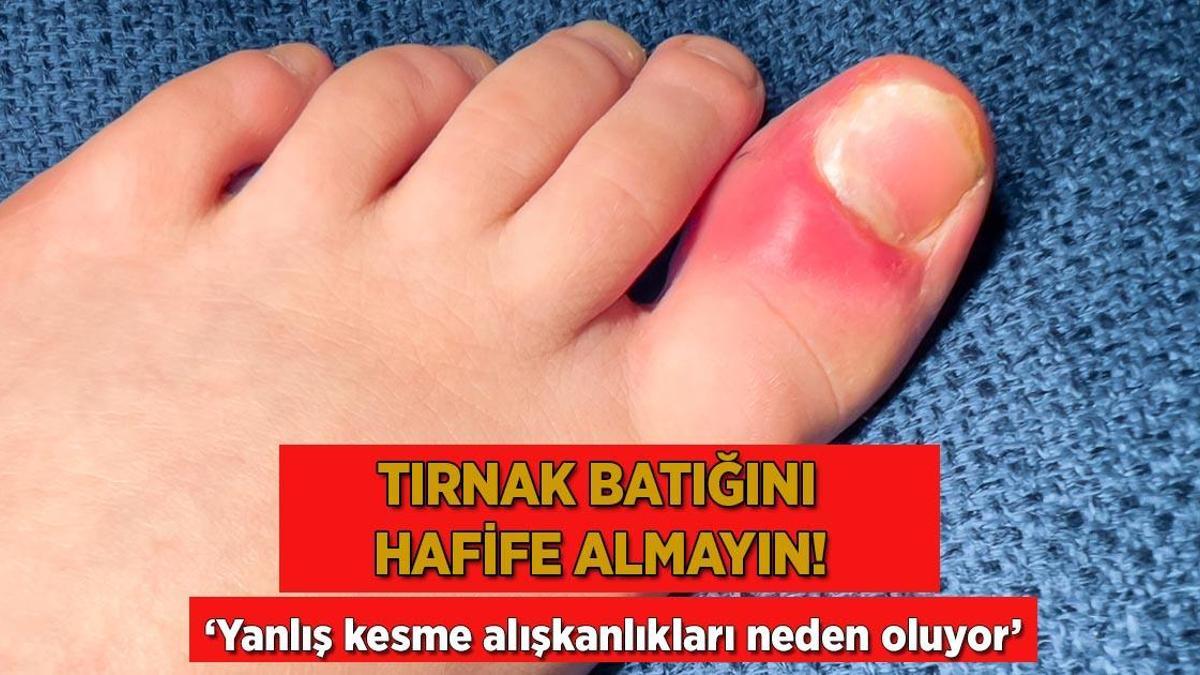 ‘Tırnak batığı’ deyip geçmeyin! Yanlış kesim topal yürütür; sebebi alışkanlıkmış